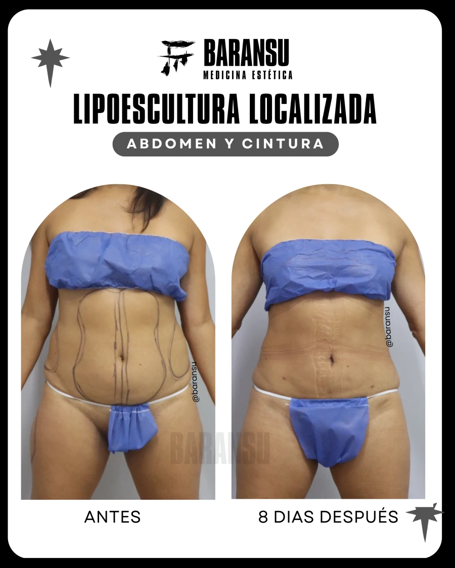 Lipoescultura Localizada (Minilipo) 54
