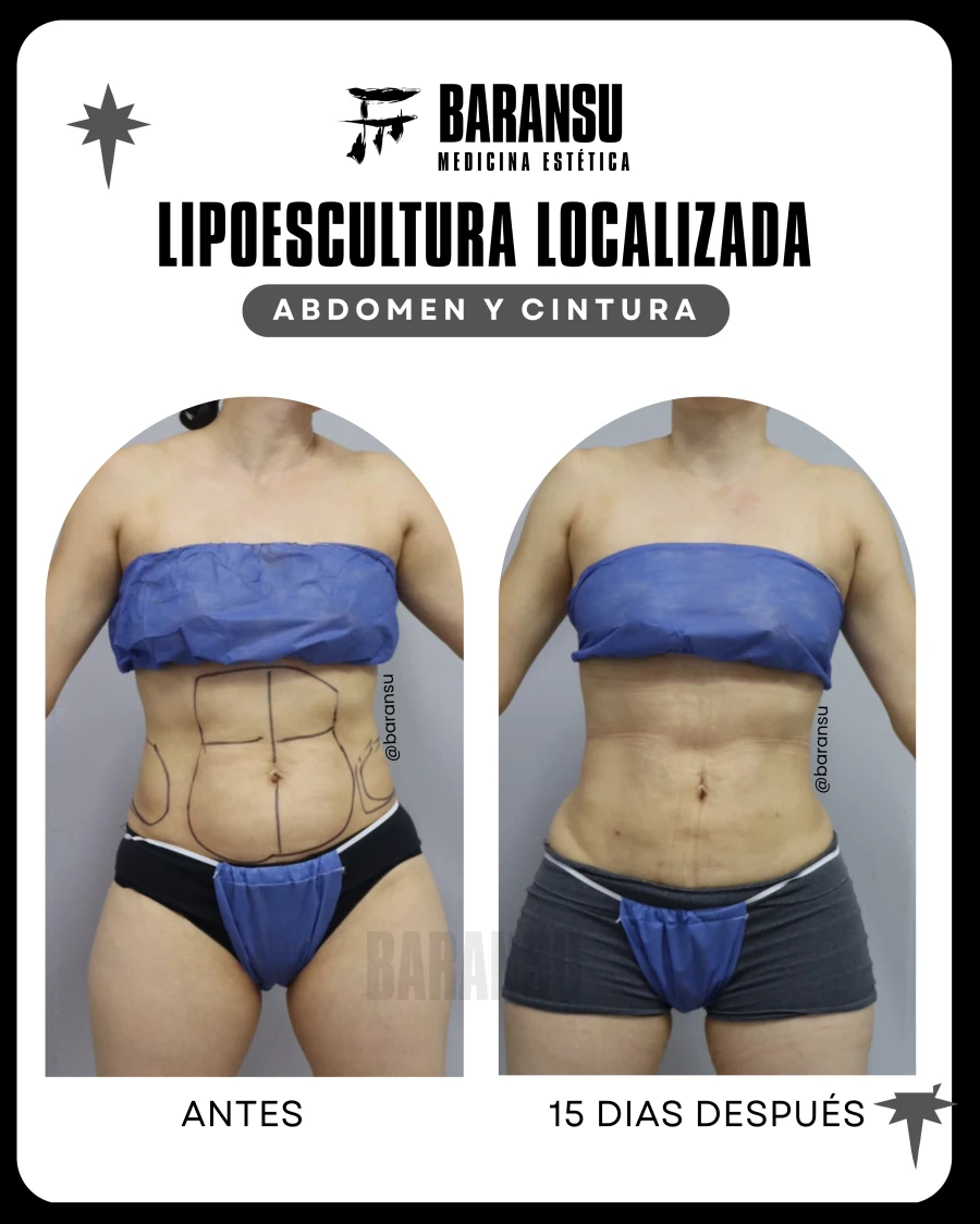 Lipoescultura Localizada (Minilipo)