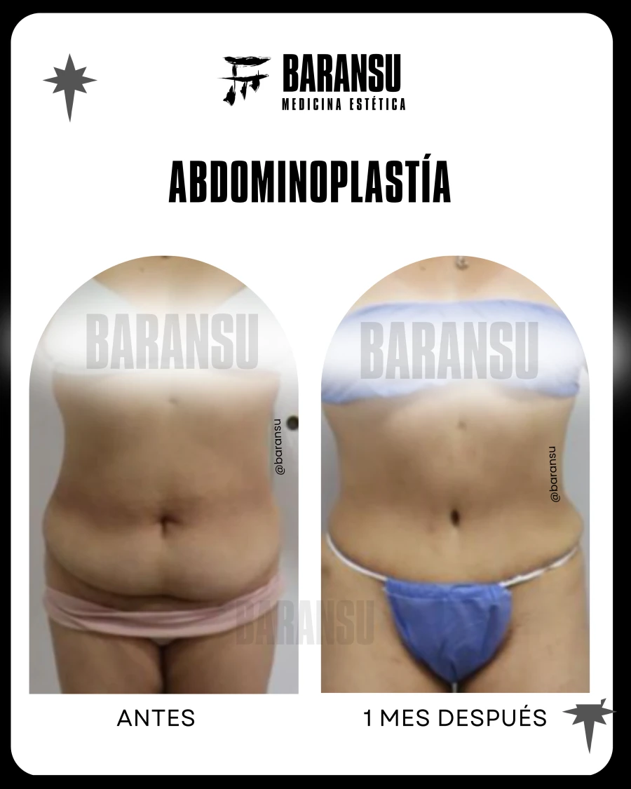 Abdominoplastía