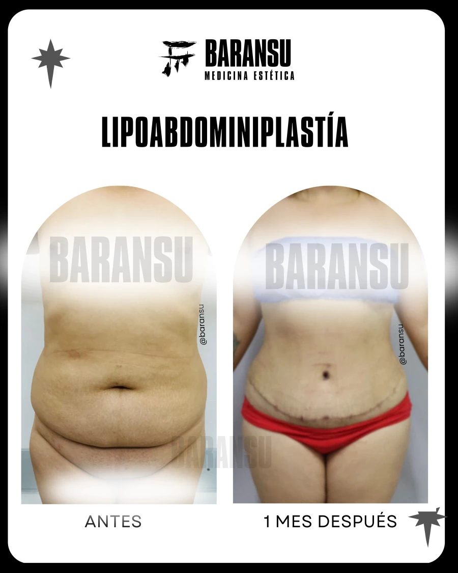 Abdominoplastía