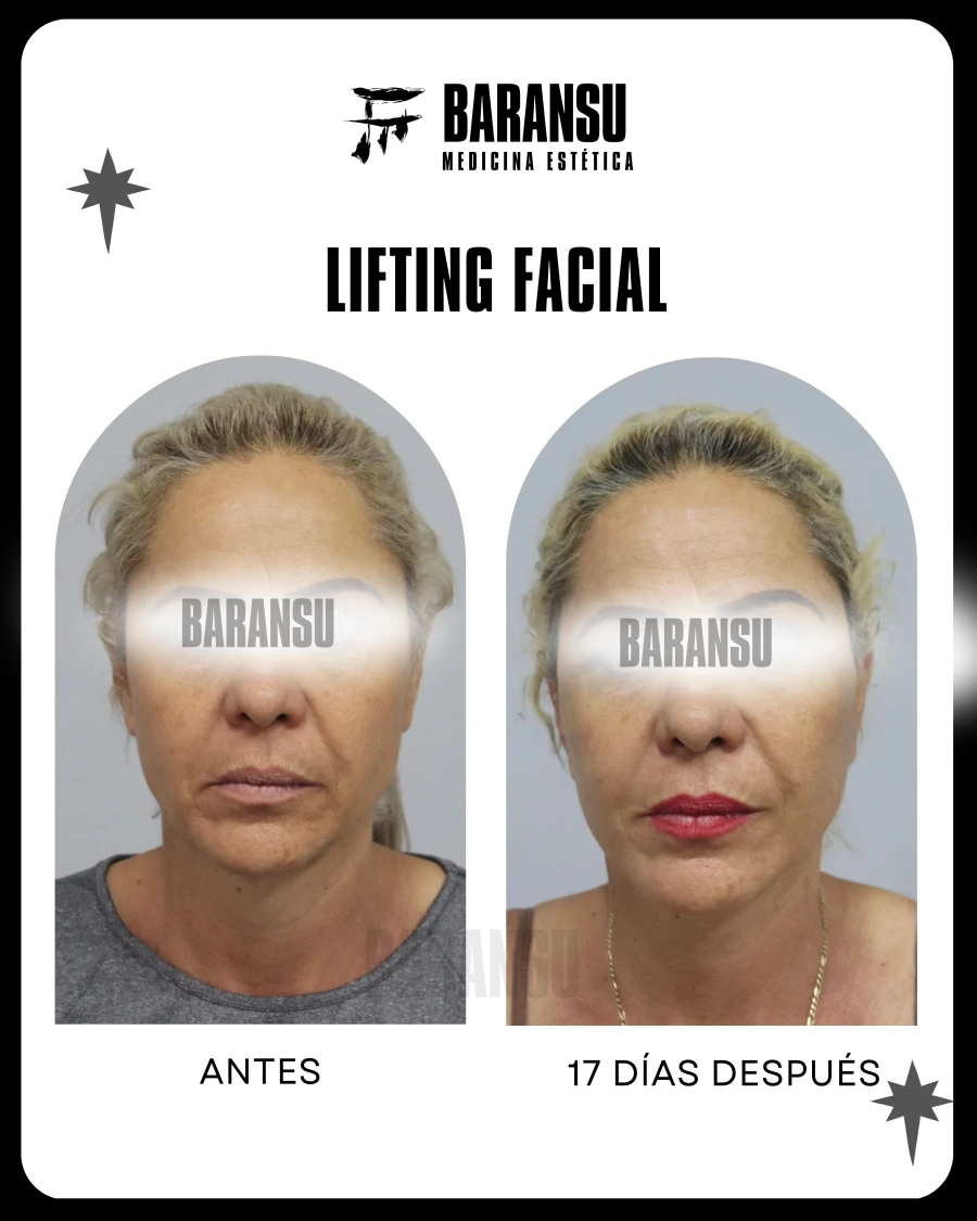 Lifting Facial 19
