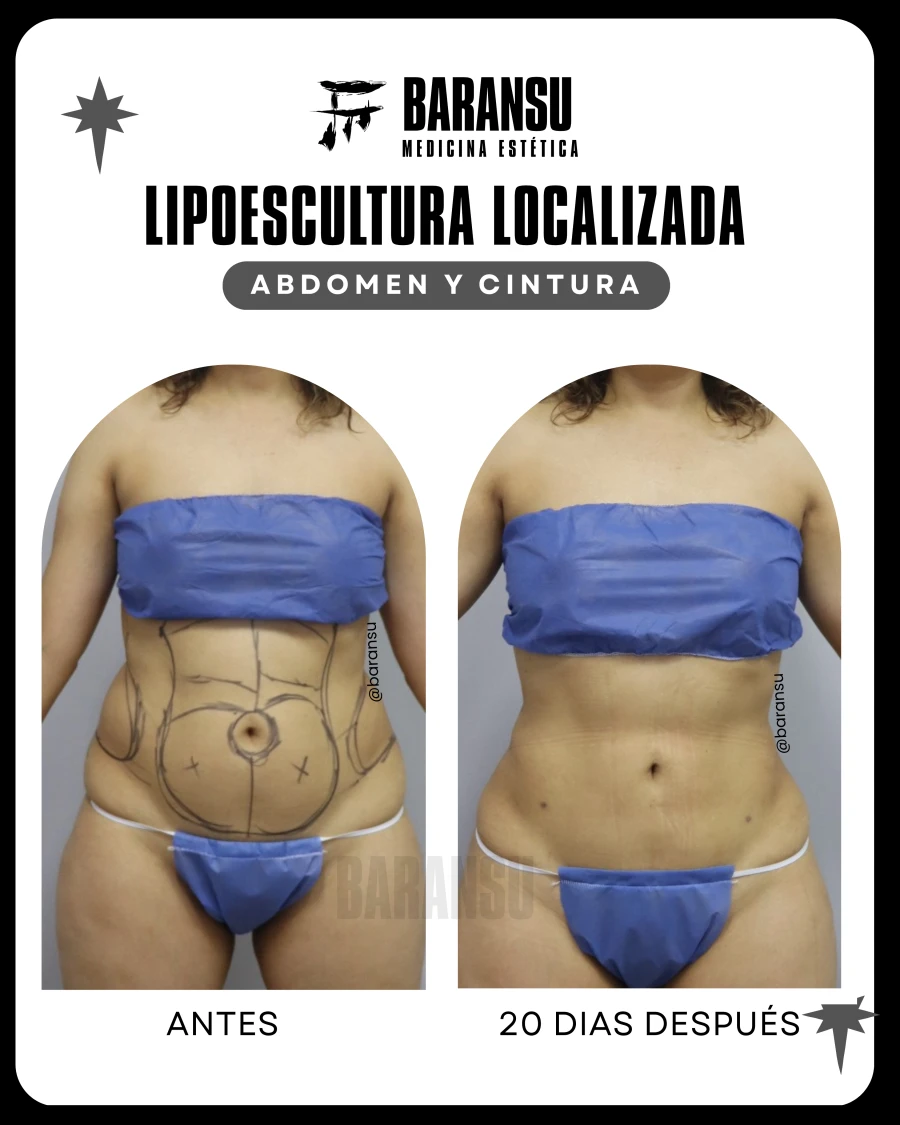 Lipoescultura Localizada (Minilipo) 55