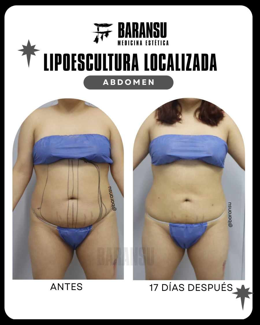 Lipoescultura Localizada (Minilipo) 52