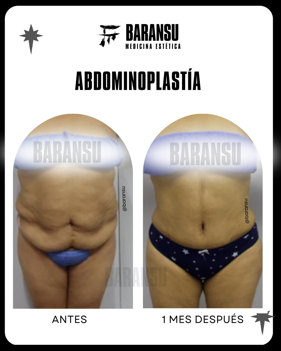 Abdominoplastía