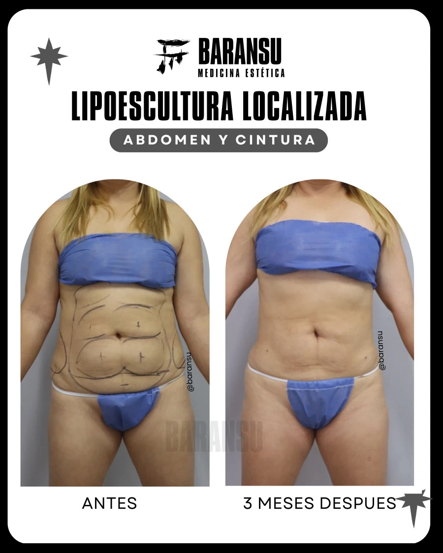 Lipoescultura Localizada (Minilipo) 53
