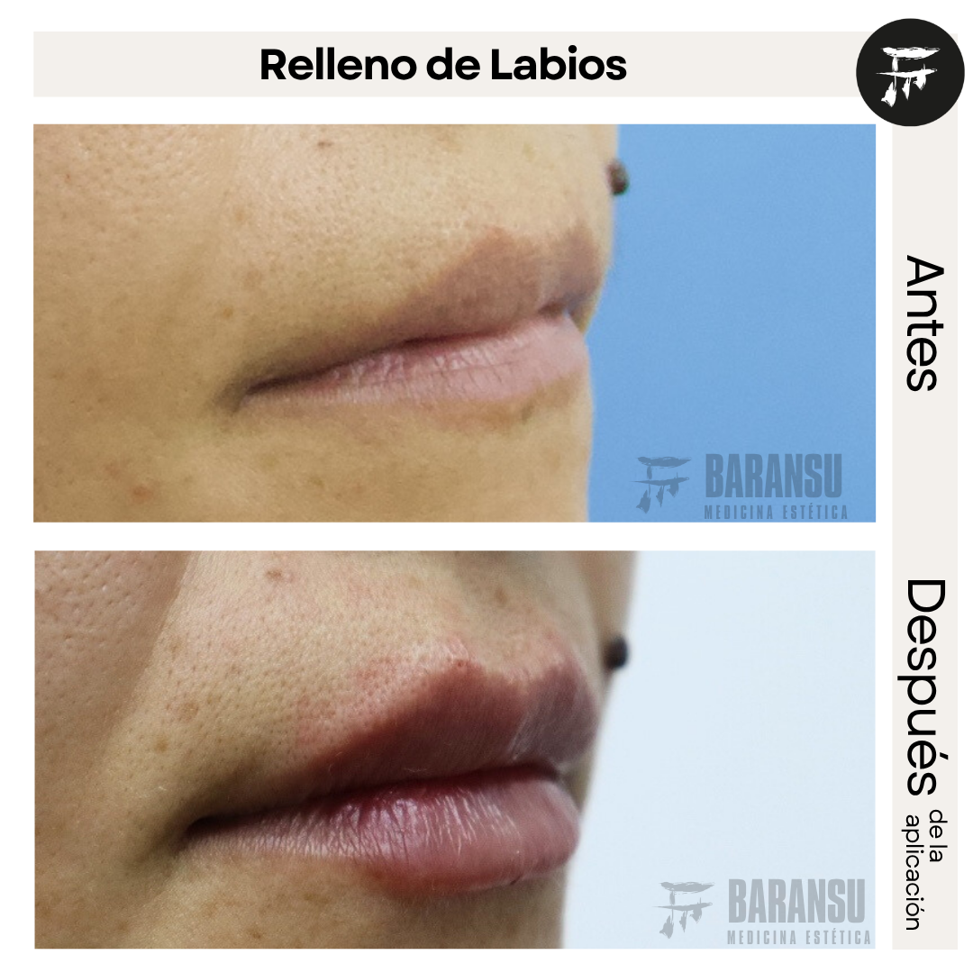 Relleno de Labios 0
