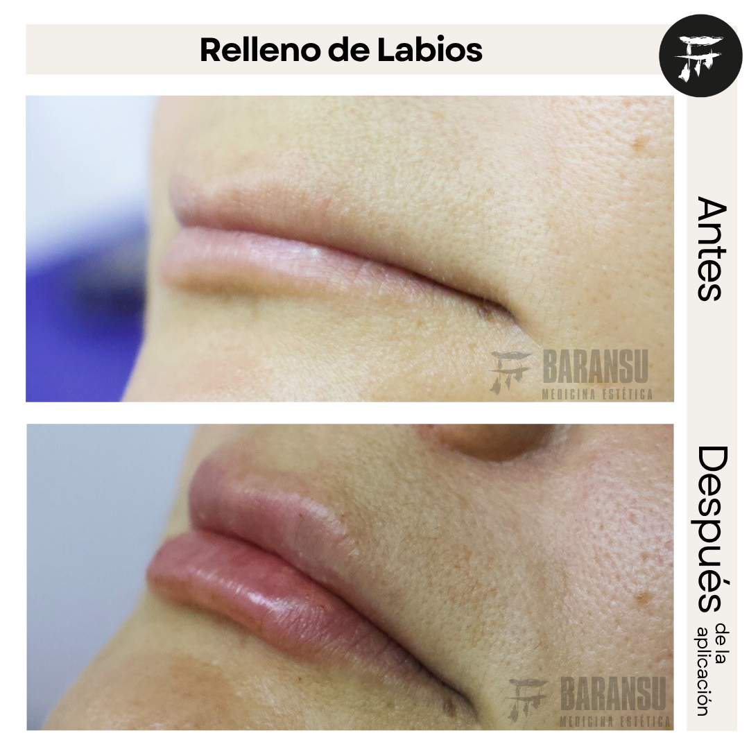 Relleno de Labios 1