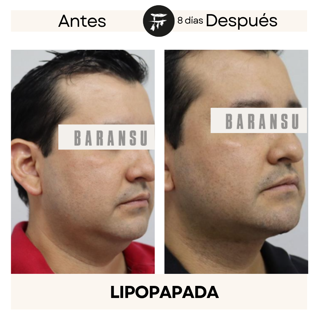 Lipo de Papada 0