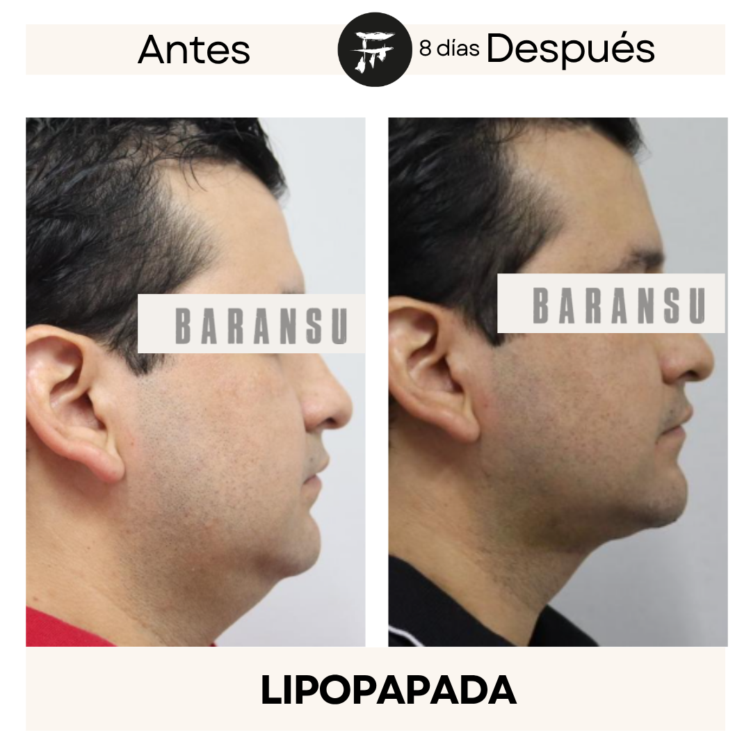 Lipo de Papada 1