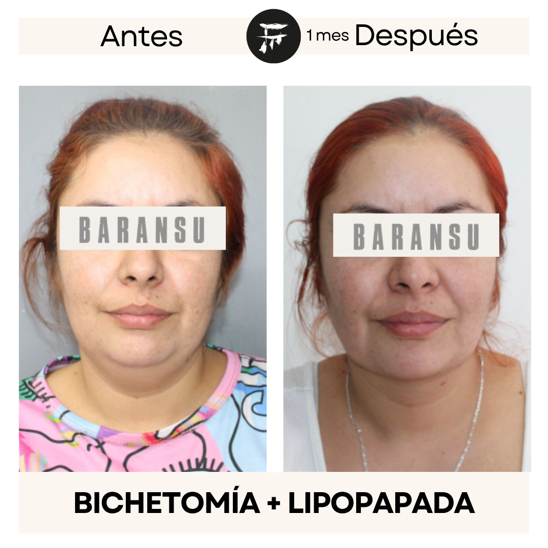 bichectomia 0