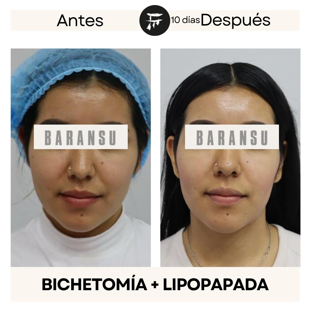 bichectomia 1