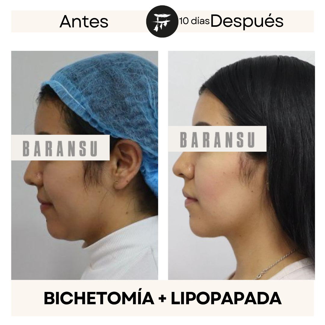 bichectomia 2