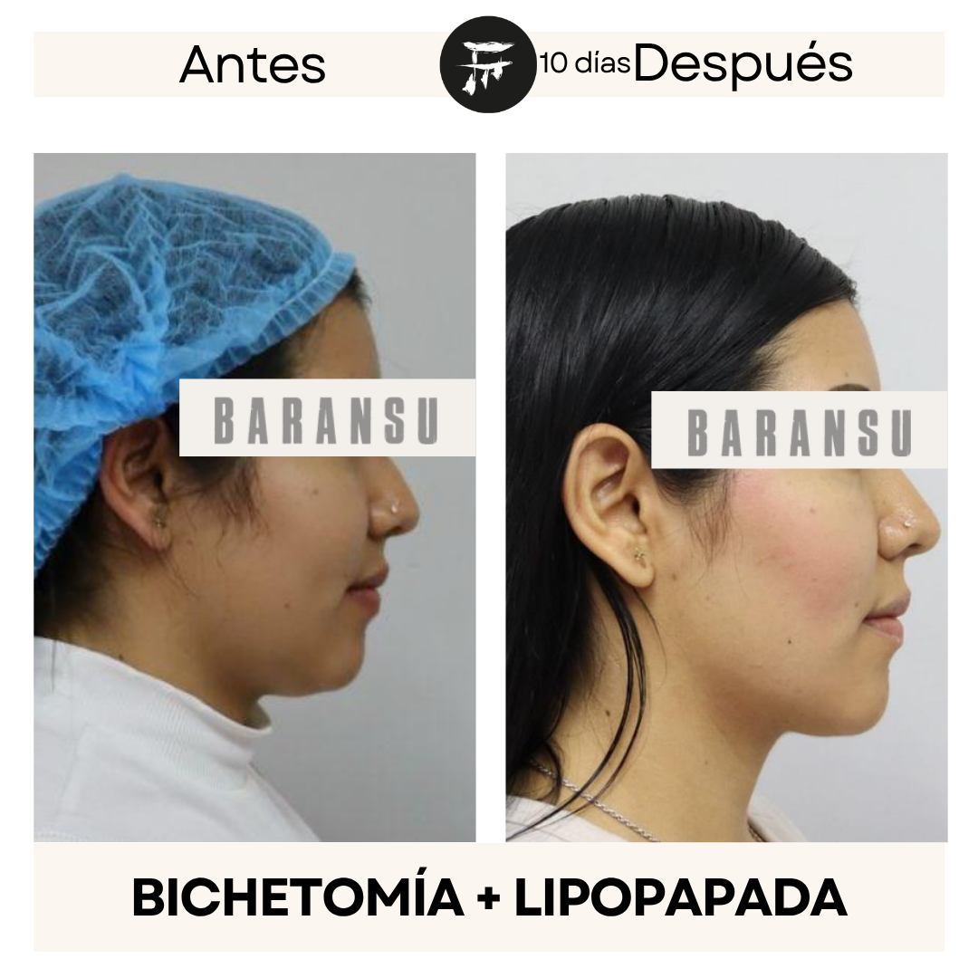 bichectomia 3