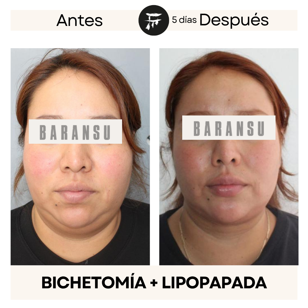 bichectomia 4