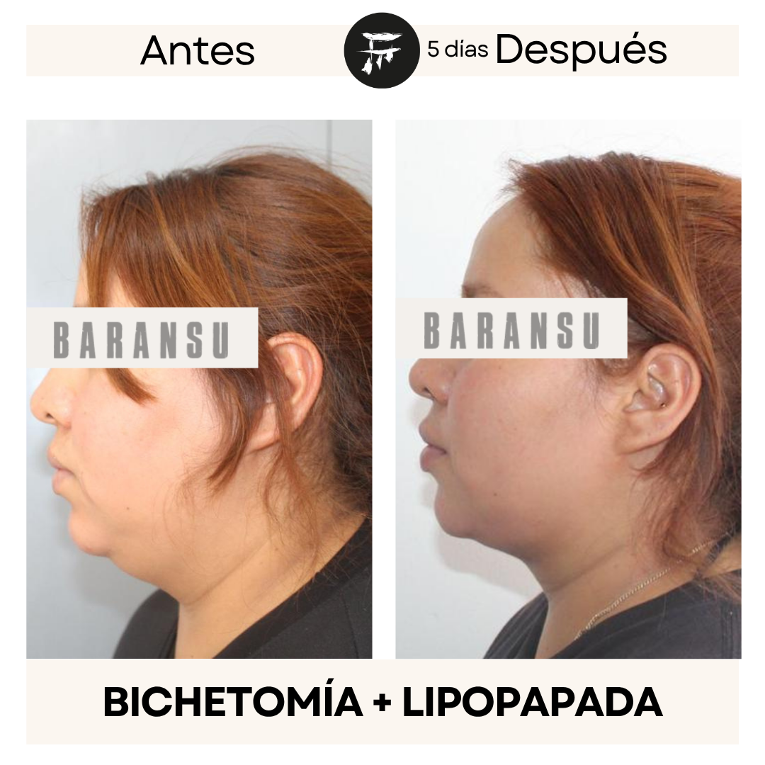bichectomia 5