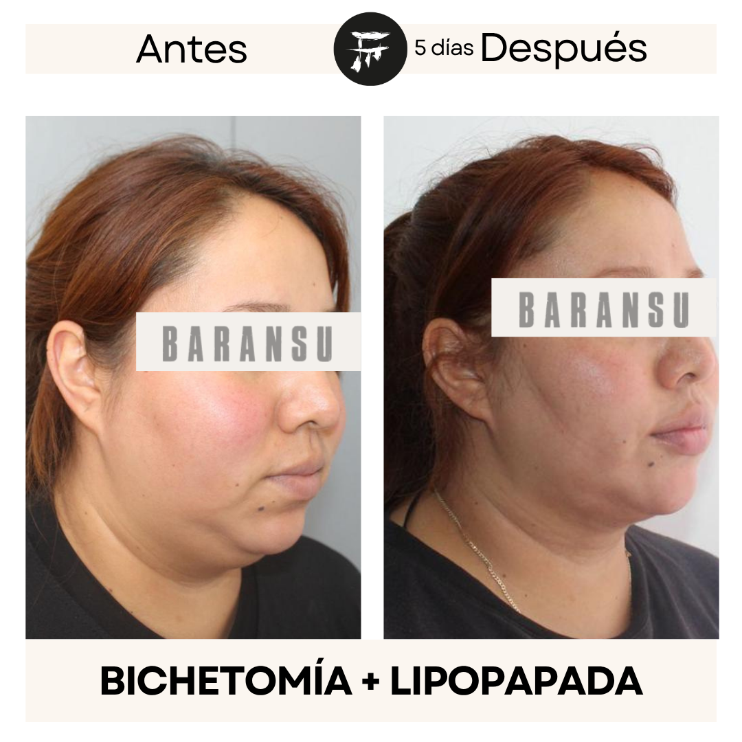 Bichectomía 6