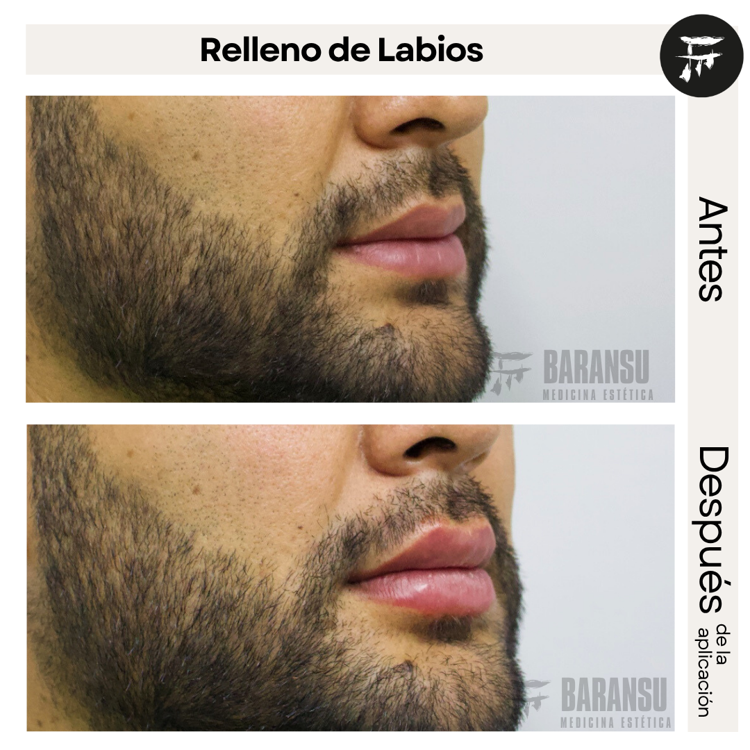 Relleno Labios 2