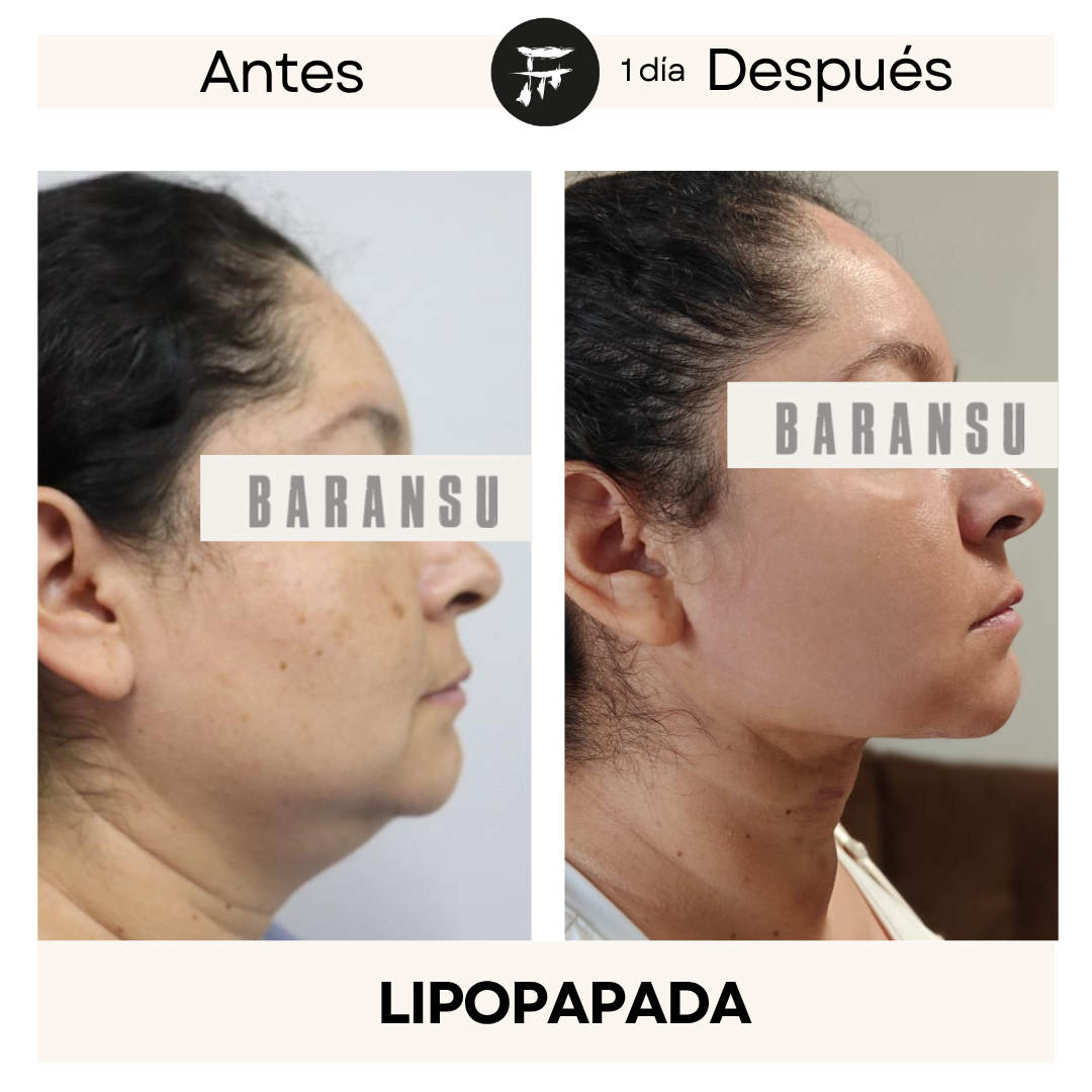 Lipo de Papada 11