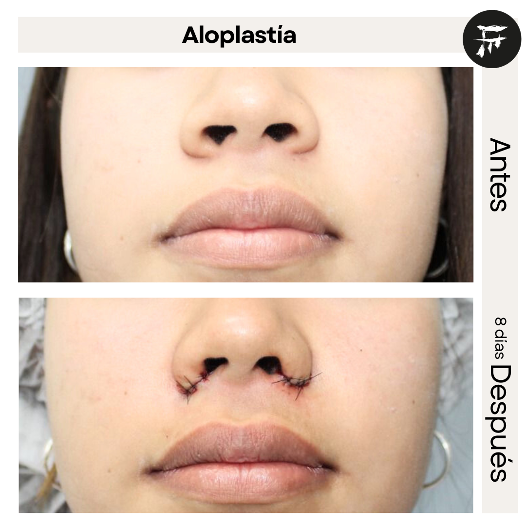 aloplastia 0
