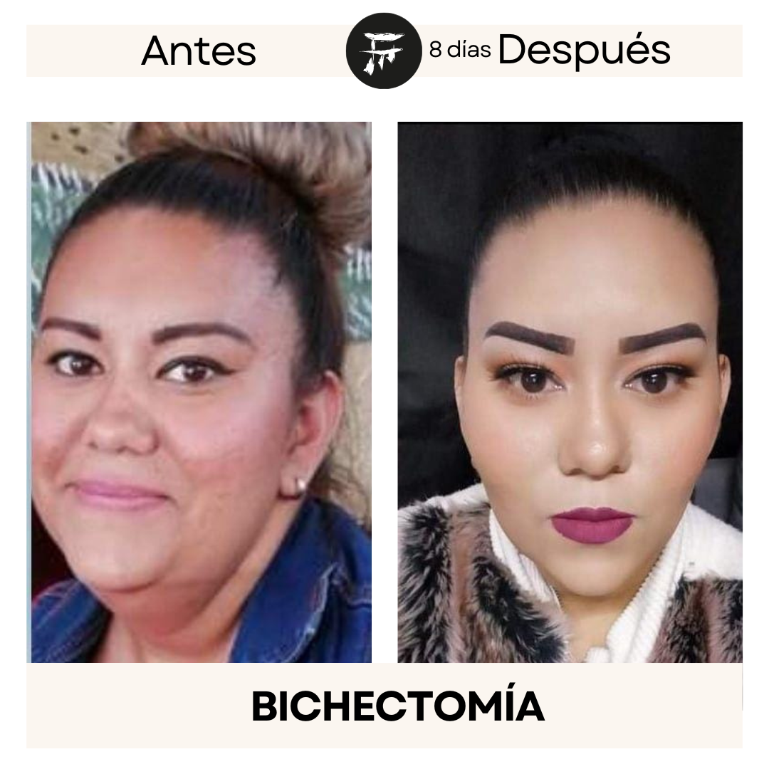 Bichectomía 7