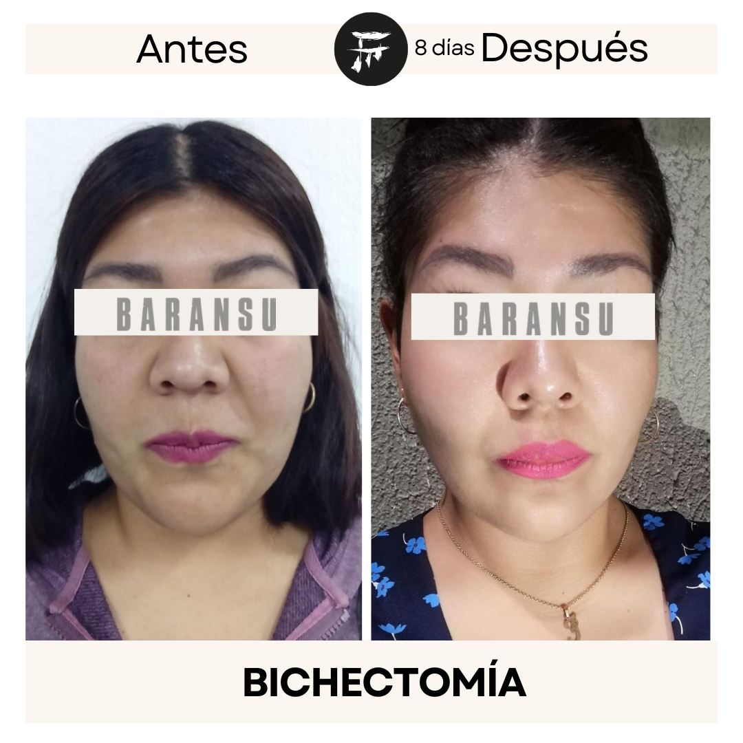 Bichectomía 8