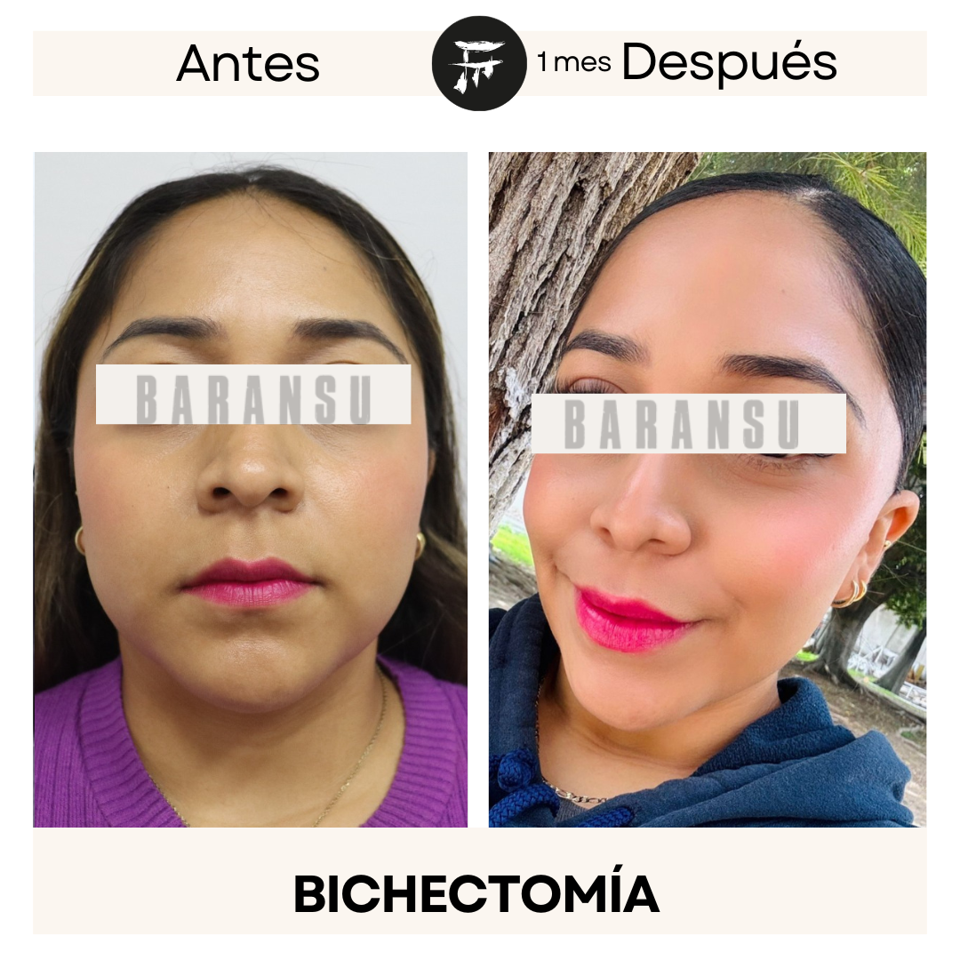 Bichectomía 9