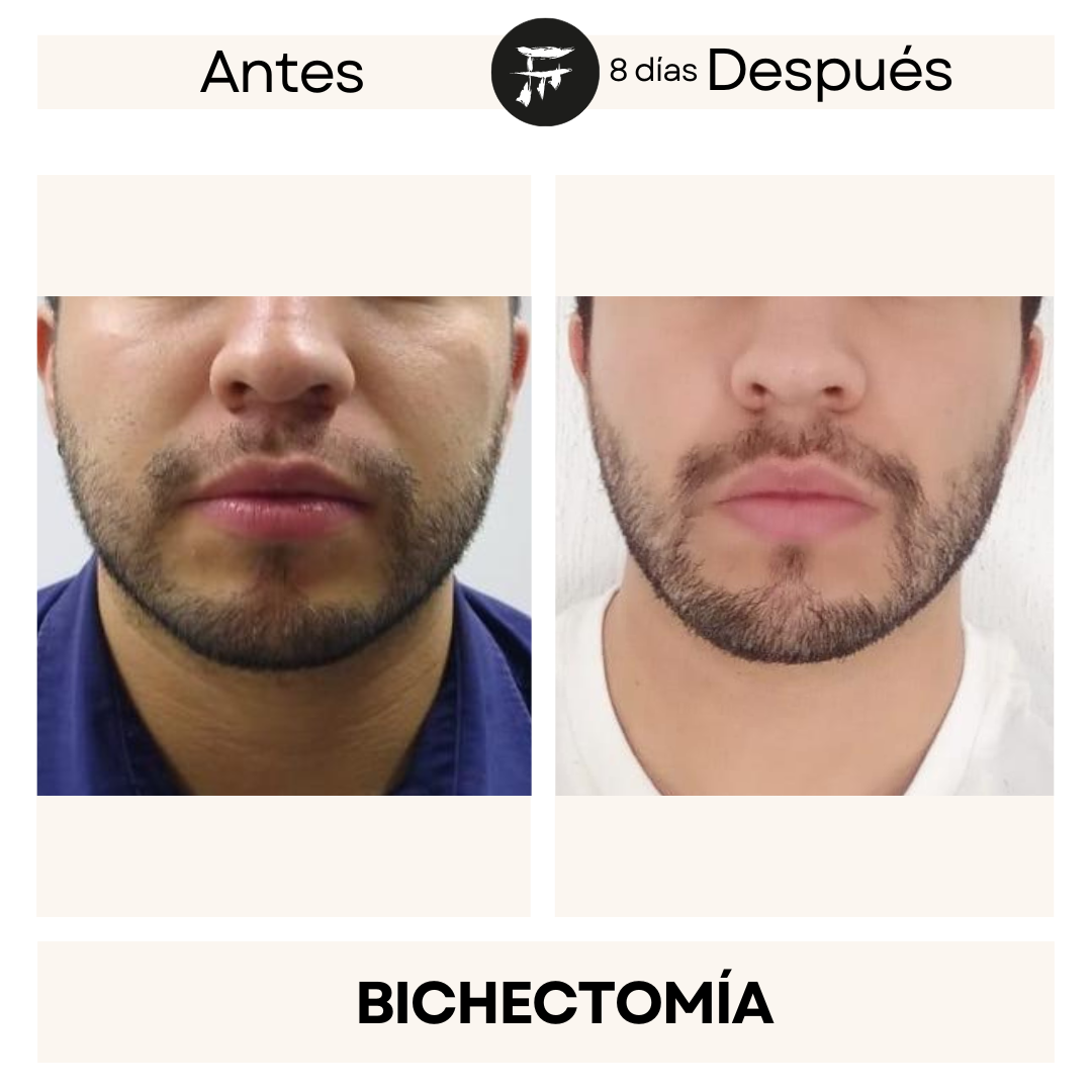 Bichectomía 10