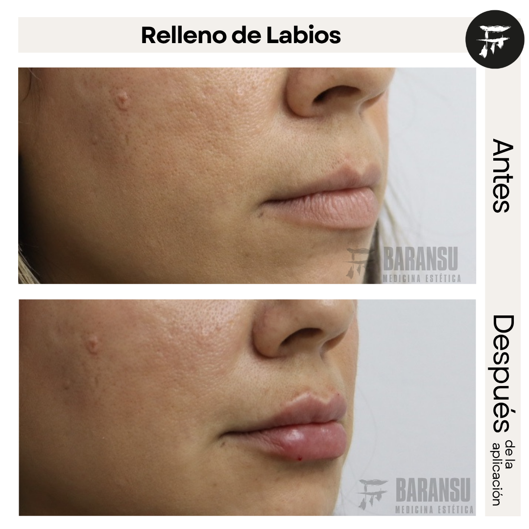 Relleno de Labios 3