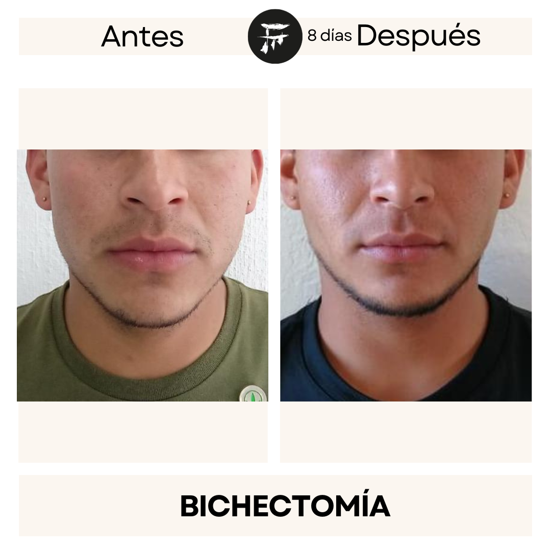 Bichectomía 11