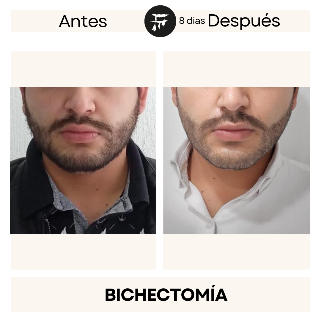 Bichectomía 12