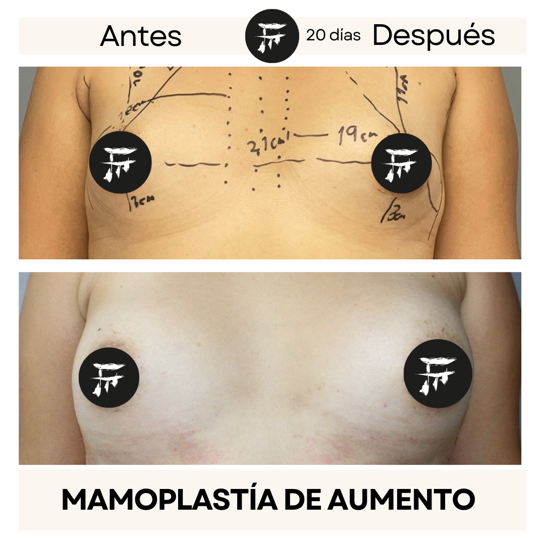 Implante Mamario 0