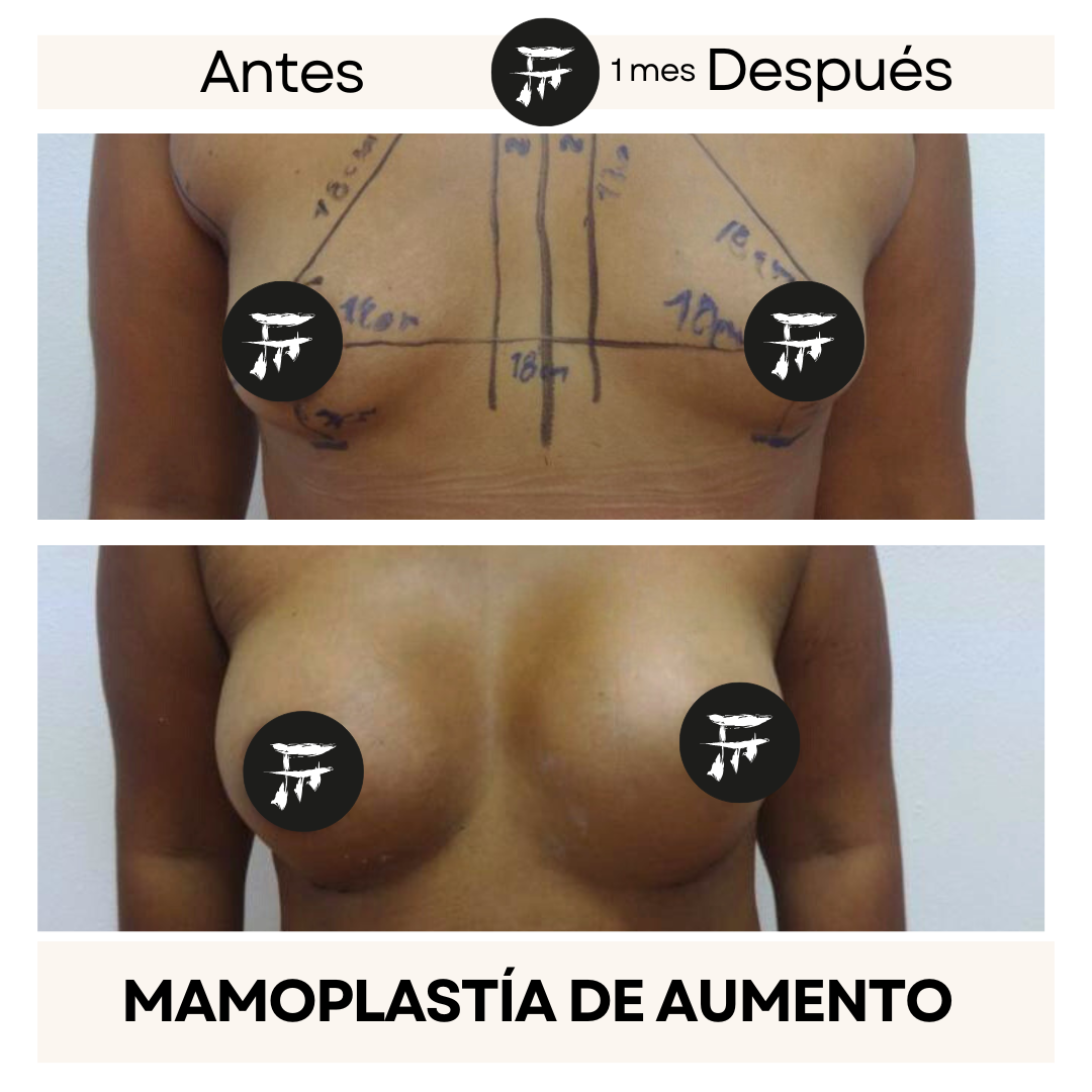 Implante Mamario 1