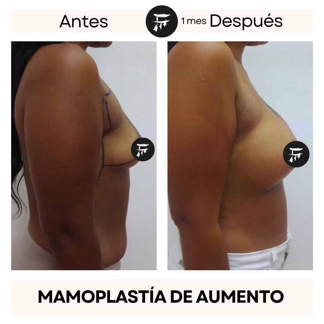 Implante Mamario 2