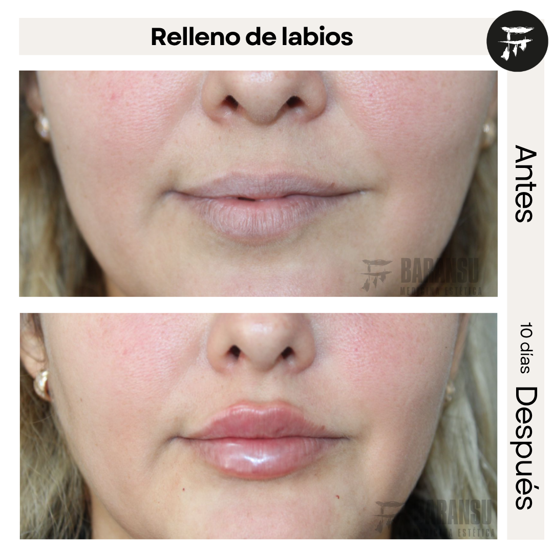 Relleno de Labios 5