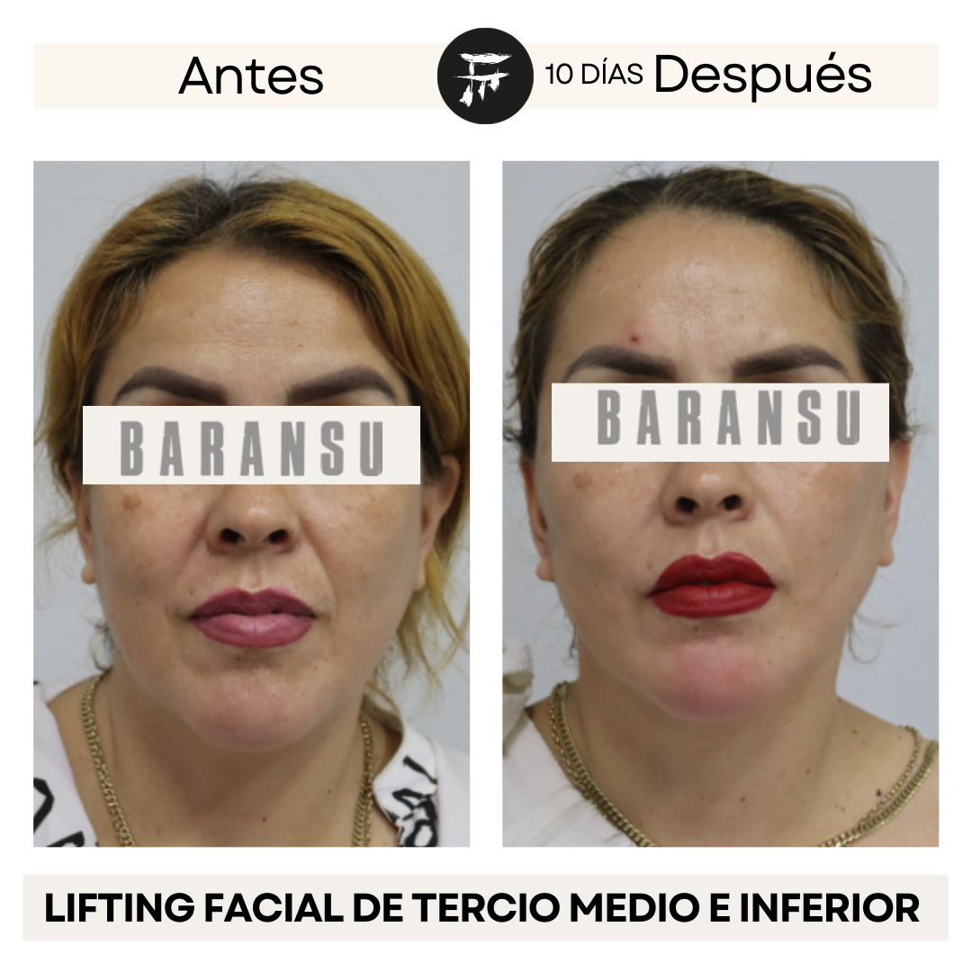 Lifting Facial de Tercio Medio e Inferior 0