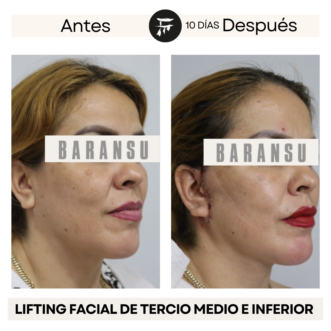 Lifting Facial de Tercio Medio e Inferior 1
