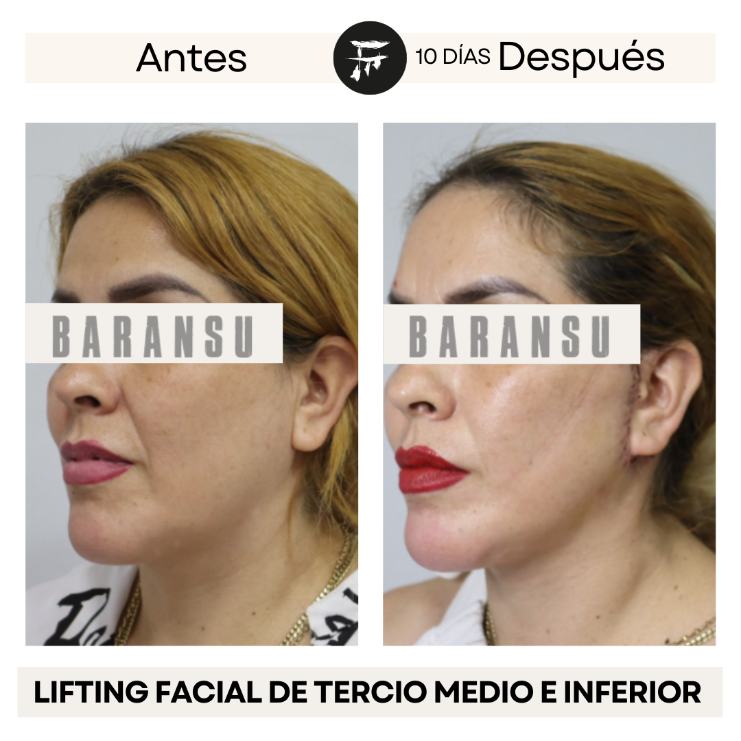 Lifting Facial de Tercio Medio e Inferior 2