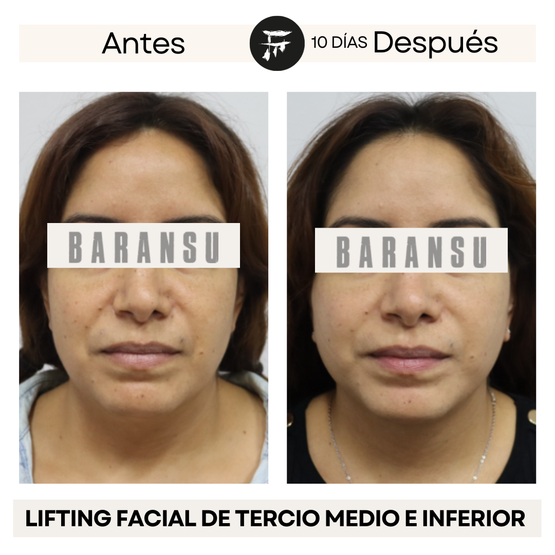 Lifting Facial de Tercio Medio e Inferior 3