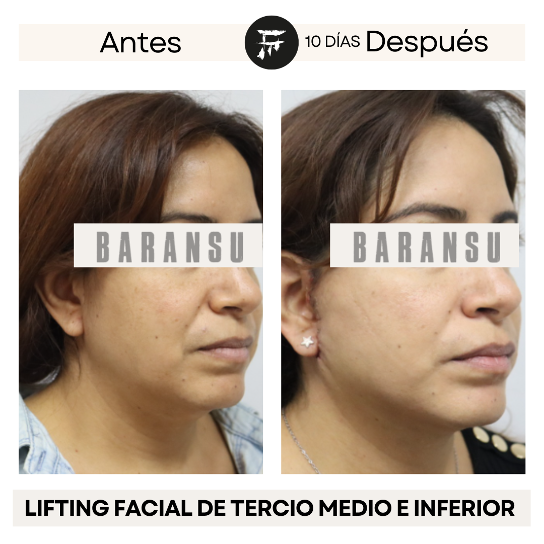 Lifting Facial de Tercio Medio e Inferior 4