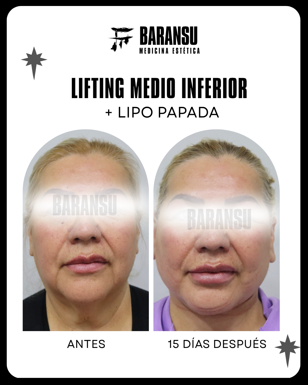 Lifting Medio Inferior Facial + Lipo Papada 5