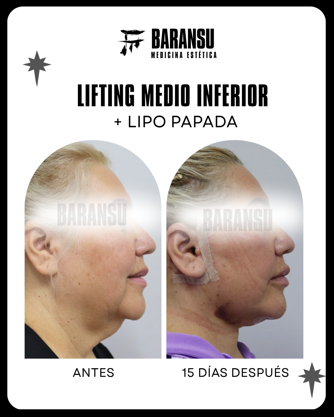 Lifting Medio Inferior Facial + Lipo Papada 6