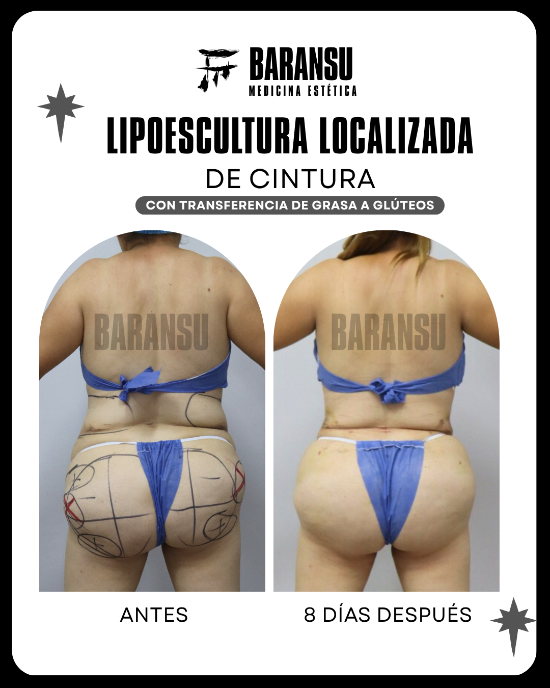 Lipoescultura Localizada (Minilipo) 1