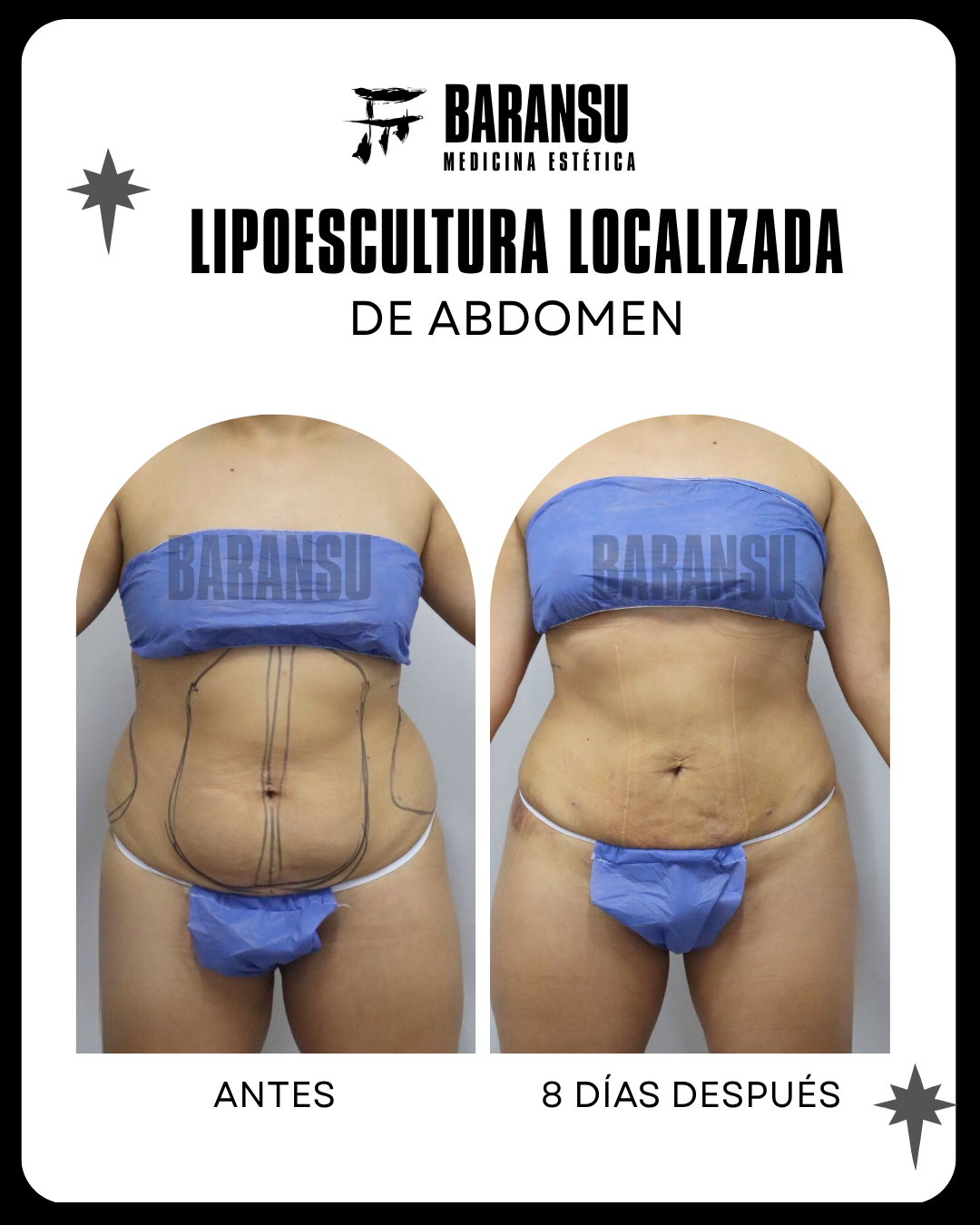 Lipoescultura Localizada (Minilipo) 2