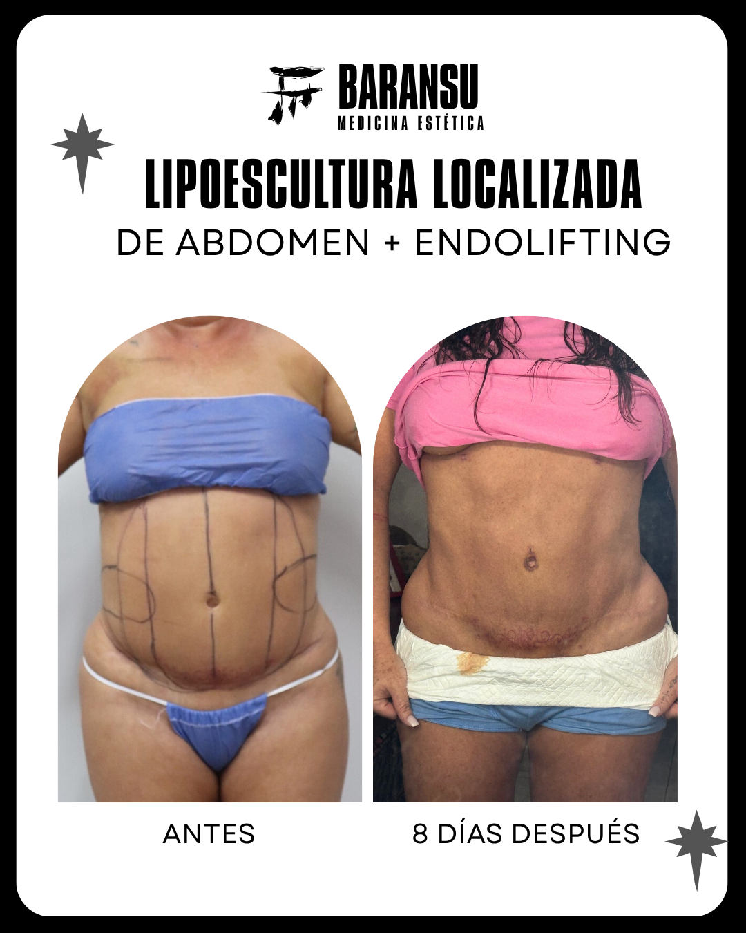 Lipoescultura Localizada (Minilipo) 5