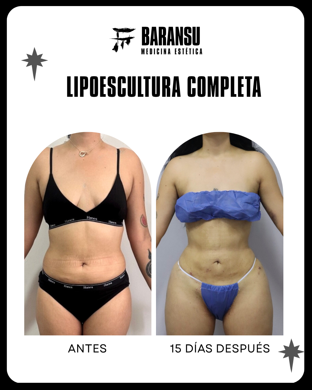 Lipoescultura Completa 0