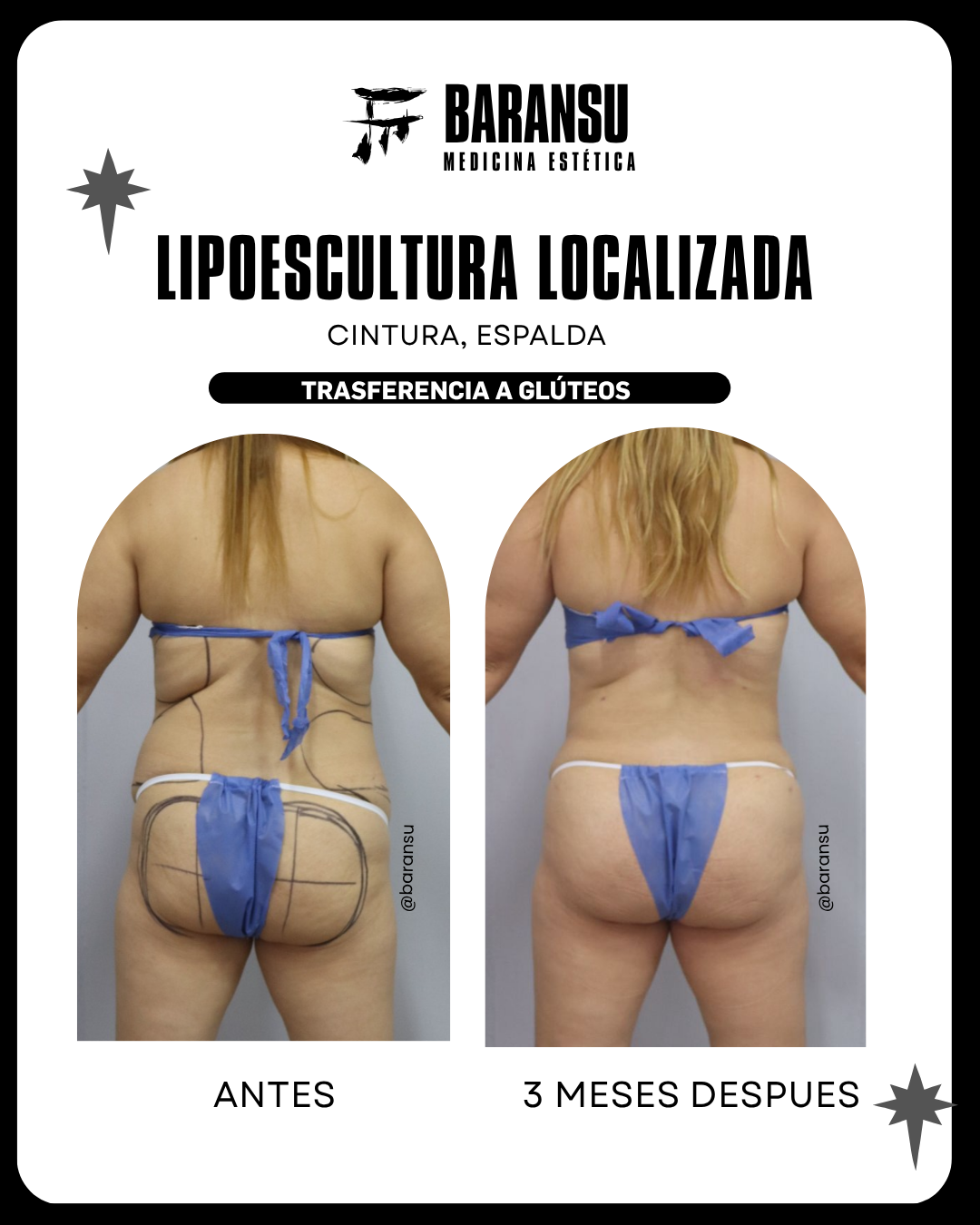 Lipoescultura Localizada (Minilipo)1