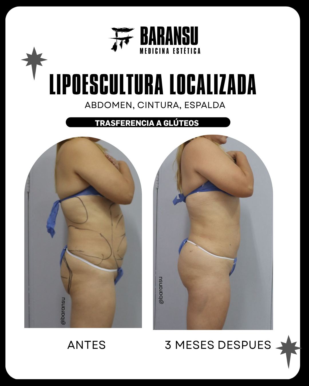 Lipoescultura Localizada (Minilipo)3