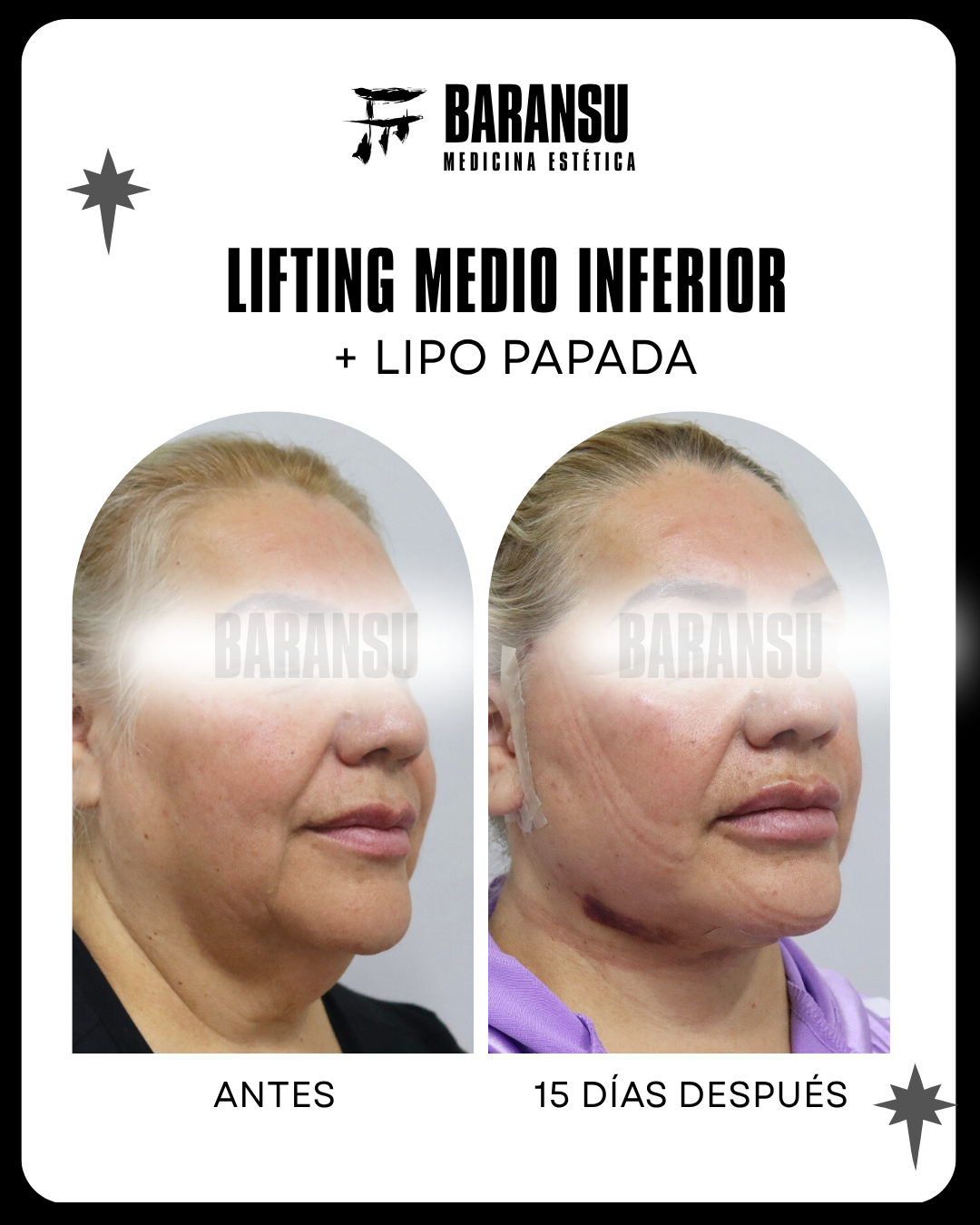 Lifting Medio Inferior Facial + Lipo Papada 7