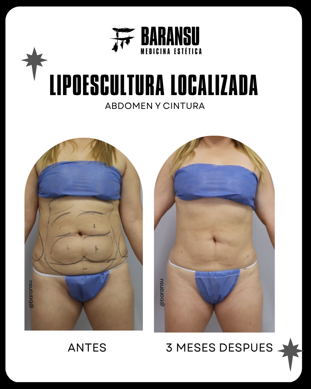 Lipoescultura Localizada 4
