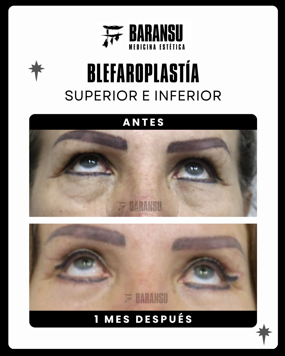 Blefaroplastía Superior e Inferior 5